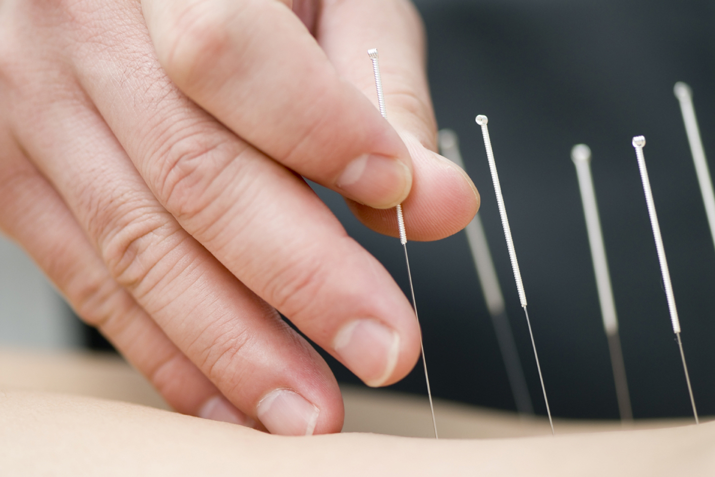 Myotherapy – Dry Needling – Massage Therapia